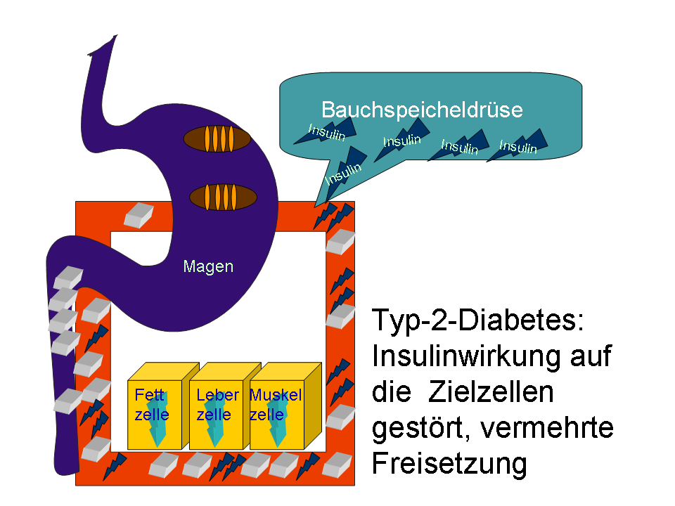 Diabetes-Typ-2